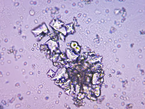 Urine Test Microscopic urinalysis, Uric Acid, Calcium oxalate